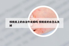 核桃皮上的水治牛皮癬嗎 核桃皮的水怎么洗掉