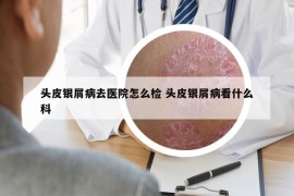 頭皮銀屑病去醫(yī)院怎么檢 頭皮銀屑病看什么科