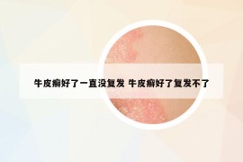 牛皮癬好了一直沒(méi)復(fù)發(fā) 牛皮癬好了復(fù)發(fā)不了