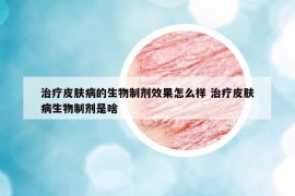 治療皮膚病的生物制劑效果怎么樣 治療皮膚病生物制劑是啥