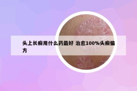 頭上長癬用什么藥最好 治愈100%頭癬偏方