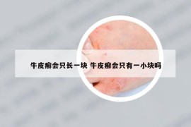 牛皮癬會(huì)只長(zhǎng)一塊 牛皮癬會(huì)只有一小塊嗎