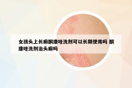 女孩頭上長(zhǎng)癬酮康唑洗劑可以長(zhǎng)期使用嗎 酮康唑洗劑治頭癬嗎