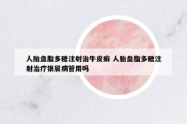 人胎盤脂多糖注射治牛皮癬 人胎盤脂多糖注射治療銀屑病管用嗎