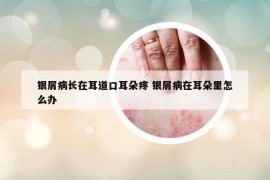 銀屑病長(zhǎng)在耳道口耳朵疼 銀屑病在耳朵里怎么辦