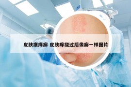 皮膚瘙癢癬 皮膚癢撓過(guò)后像癬一樣圖片