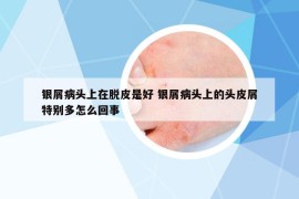 銀屑病頭上在脫皮是好 銀屑病頭上的頭皮屑特別多怎么回事
