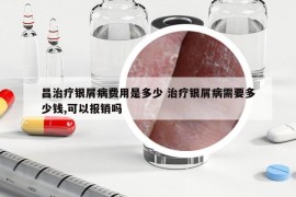 昌治療銀屑病費(fèi)用是多少 治療銀屑病需要多少錢(qián),可以報(bào)銷(xiāo)嗎