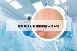 銀屑病傳人不 銀屑病會(huì)人傳人嗎