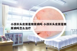 小孩長頭皮屑是銀屑病嗎 小孩長頭皮屑是銀屑病嗎怎么治療