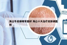 ?？谂Ｆぐ_哪家最好 ?？谑笾委熎つw病醫(yī)院