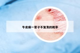 牛皮癬一輩子不復(fù)發(fā)的概率