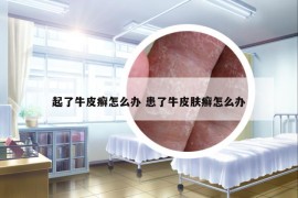 起了牛皮癬怎么辦 患了牛皮膚癬怎么辦