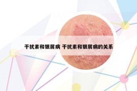 干擾素和銀屑病 干擾素和銀屑病的關(guān)系
