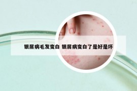銀屑病毛發(fā)變白 銀屑病變白了是好是壞