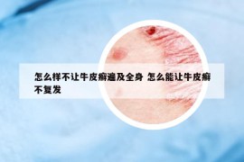 怎么樣不讓牛皮癬遍及全身 怎么能讓牛皮癬不復(fù)發(fā)