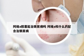 阿維a膠囊能治銀屑病嗎 阿維a和什么藥配合治銀屑病