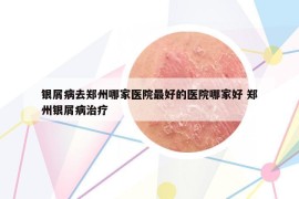 銀屑病去鄭州哪家醫(yī)院最好的醫(yī)院哪家好 鄭州銀屑病治療