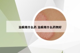 治癬用什么藥 治癬用什么藥物好