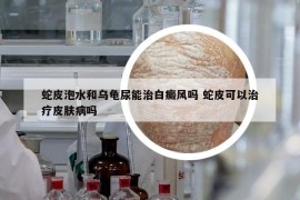 蛇皮泡水和烏龜尿能治白癜風嗎 蛇皮可以治療皮膚病嗎