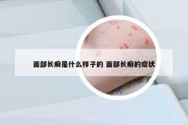 面部長癬是什么樣子的 面部長癬的癥狀