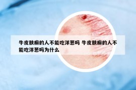 牛皮膚癬的人不能吃洋蔥嗎 牛皮膚癬的人不能吃洋蔥嗎為什么