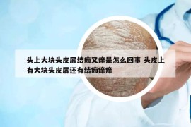 頭上大塊頭皮屑結(jié)痂又癢是怎么回事 頭皮上有大塊頭皮屑還有結(jié)痂癢癢
