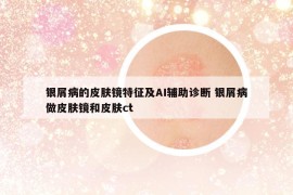 銀屑病的皮膚鏡特征及AI輔助診斷 銀屑病做皮膚鏡和皮膚ct
