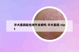 華大基因能檢測牛皮癬嗎 華大基因 nipt