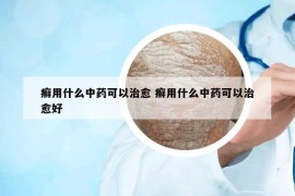 癬用什么中藥可以治愈 癬用什么中藥可以治愈好