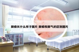 腳癬長什么樣子圖片 腳癬和腳氣的區(qū)別圖片