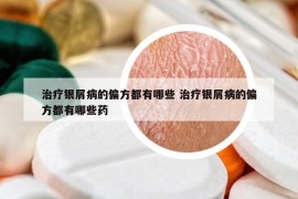 治療銀屑病的偏方都有哪些 治療銀屑病的偏方都有哪些藥