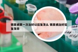 銀屑病第一次治好以后復(fù)發(fā)么 銀屑病治好后復(fù)發(fā)率