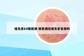 維生素k4銀屑病 銀屑病吃維生素有用嗎
