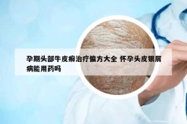 孕期頭部牛皮癬治療偏方大全 懷孕頭皮銀屑病能用藥嗎