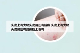 頭皮上有大塊頭皮屑還有結痂 頭皮上有大塊頭皮屑還有結痂臉上也有