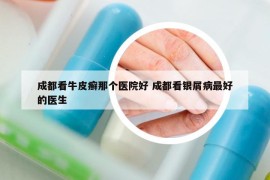 成都看牛皮癬那個(gè)醫(yī)院好 成都看銀屑病最好的醫(yī)生