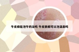 牛皮癬能泡牛奶浴嗎 牛皮膚癬可以泡溫泉嗎