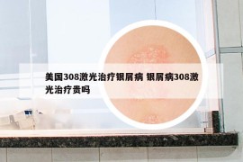 美國308激光治療銀屑病 銀屑病308激光治療貴嗎