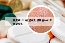 銀屑病2023有望攻克 銀屑病2022年有望攻克