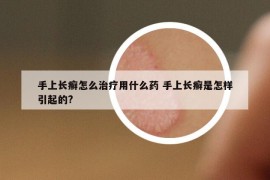 手上長癬怎么治療用什么藥 手上長癬是怎樣引起的?