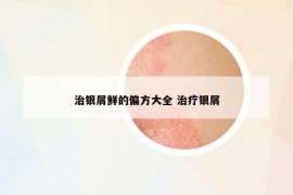 治銀屑鮮的偏方大全 治療銀屑