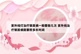 紫外線燈治療銀屑病一般要做幾次 紫外線治療銀屑病需要照多長時(shí)間