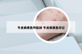 牛皮癬黑色咋能掉 牛皮癬黑色印記