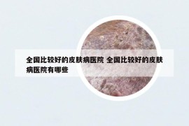 全國比較好的皮膚病醫(yī)院 全國比較好的皮膚病醫(yī)院有哪些
