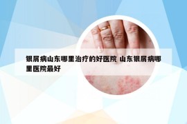 銀屑病山東哪里治療的好醫(yī)院 山東銀屑病哪里醫(yī)院最好