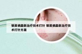 銀屑病最新治療技術(shù)打針 銀屑病最新治療技術(shù)打針方案