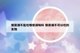 銀屑病不能吃哪些調(diào)味料 銀屑病不可以吃的食物