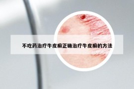不吃藥治療牛皮癬正確治療牛皮癬的方法
