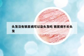 頭發(fā)沒(méi)有銀屑病可以染頭發(fā)嗎 銀屑病不長(zhǎng)頭發(fā)